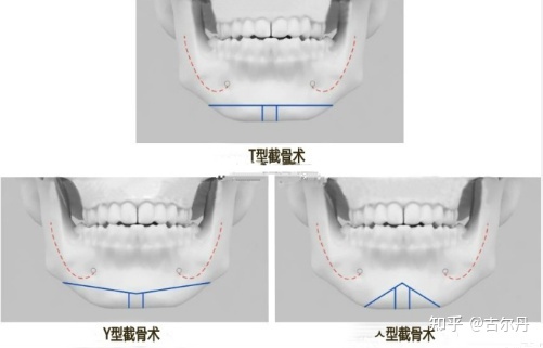 截骨头示意图